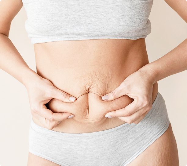 Eine Person in grauer Unterwäsche und einem Crop-Top kneift sich die lose Haut am Bauch zusammen und zeigt so die Elastizität der Haut.