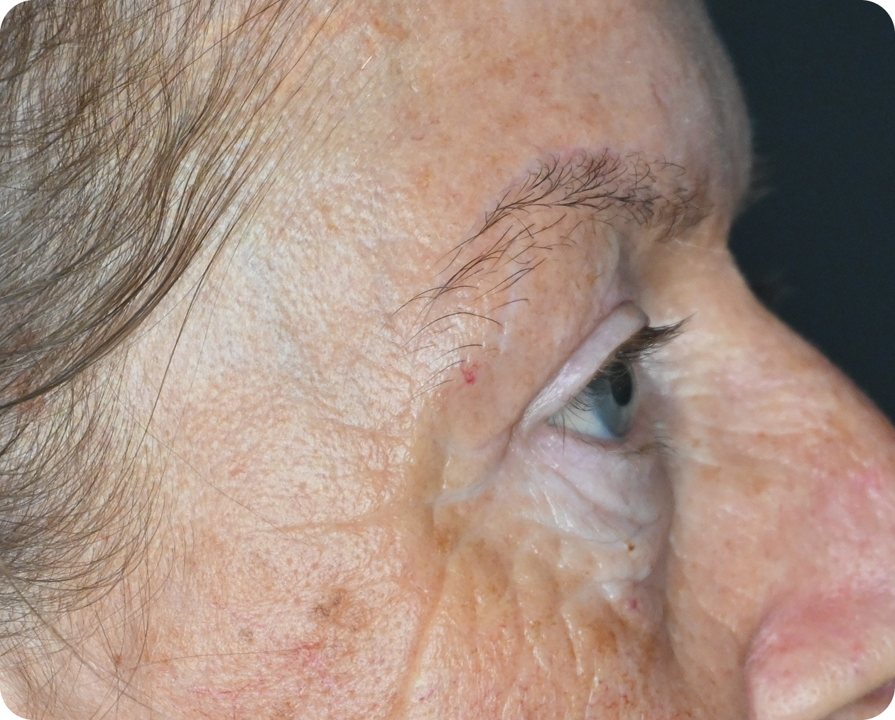 Seitliche Nahaufnahme des Gesichts einer älteren Person, die Falten, Altersflecken und spärliches Augenbrauenhaar zeigt.