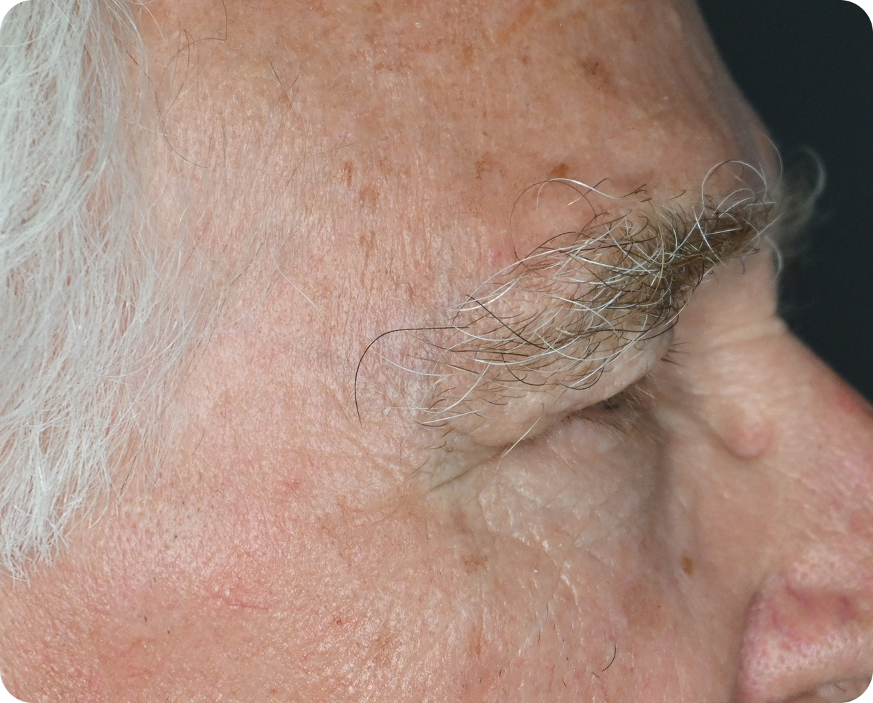 Seitliche Nahaufnahme des Gesichts einer älteren Person mit faltiger Haut, Altersflecken, weißem Haar und einem großen Muttermal in der Nähe der Nase.