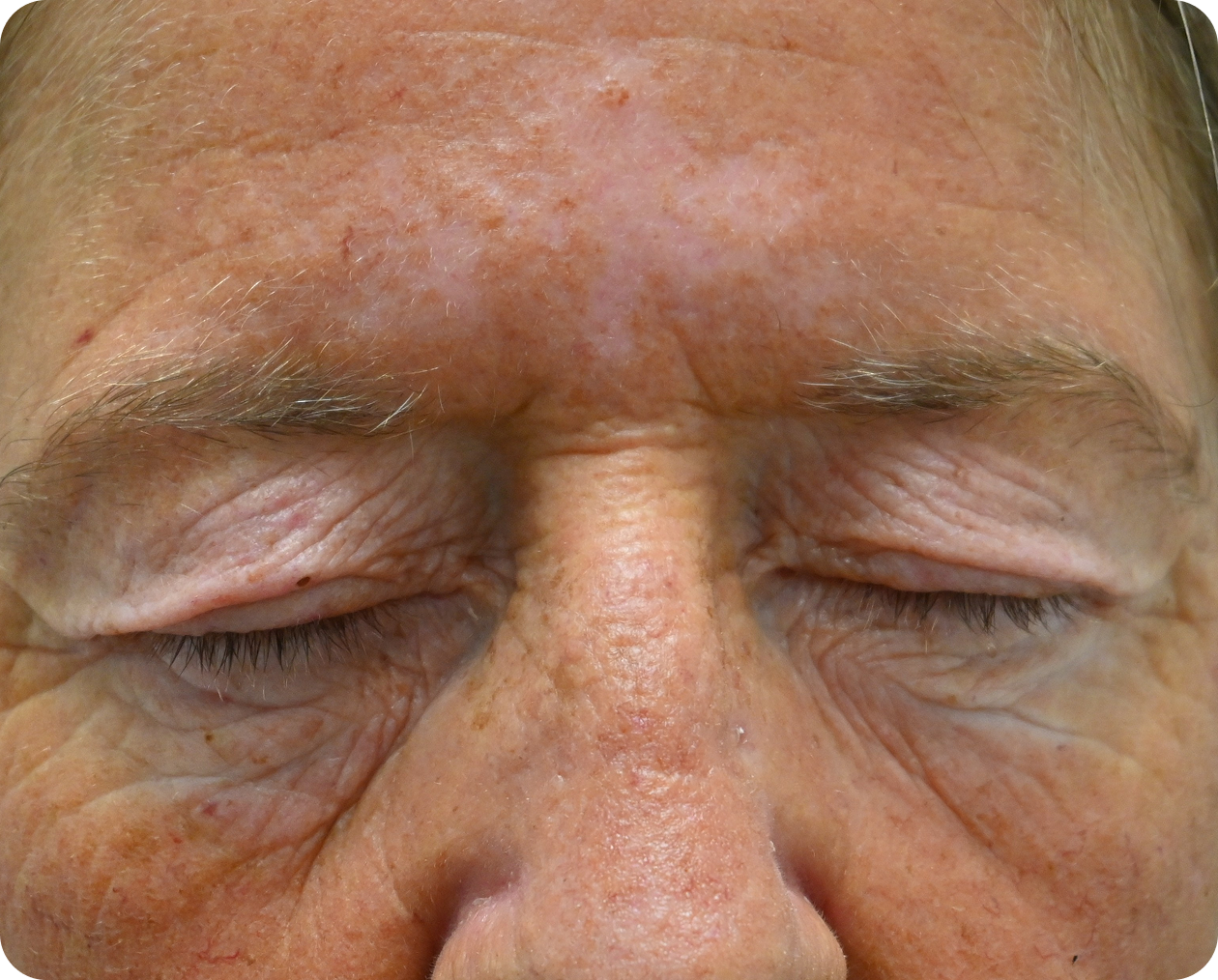 Nahaufnahme des Gesichts einer Person mit geschlossenen Augen, die sichtbare Falten, feine Linien und von der Sonne geschädigte Haut zeigt.
