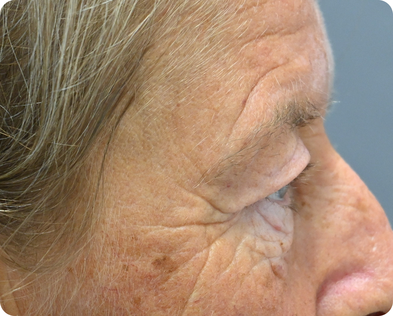 Seitliche Nahaufnahme des Gesichts einer älteren Person mit Falten, feinen Linien und Altersflecken auf der Haut in der Nähe von Auge und Schläfe.