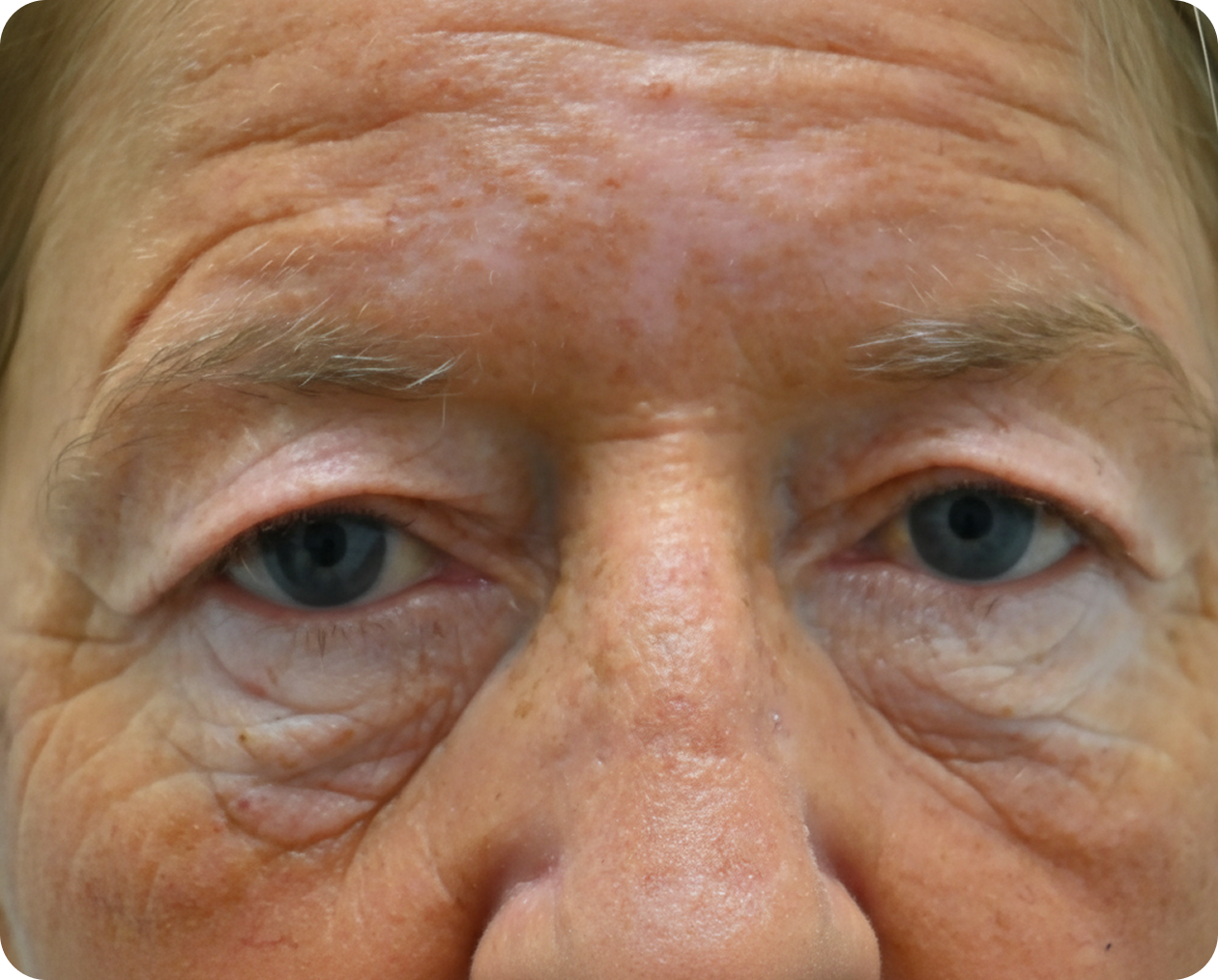 Nahaufnahme des Gesichts einer älteren Person, mit Schwerpunkt auf den Augen und den oberen Wangen, die Falten, feine Linien und schlaffe Haut um die Augenlider zeigen.