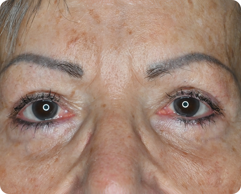 Nahaufnahme des Gesichts einer älteren Person, die beide Augen zeigt, mit sichtbaren Anzeichen von Rötung und Reizung in den Augen und Falten auf der umgebenden Haut.