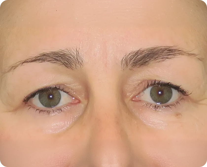 Nahaufnahme der Augen und Augenbrauen einer Person, die eine asymmetrische Augenbrauenform und spärliches Augenbrauenhaar zeigt.