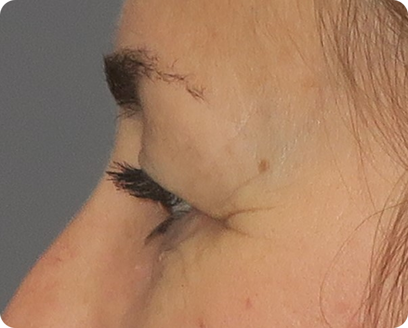 Seitliche Nahaufnahme des Gesichts einer Person, wobei der Schwerpunkt auf dem oberen Augenlid liegt und das Fehlen von Augenbrauenhaaren am äußeren Rand auffällt.