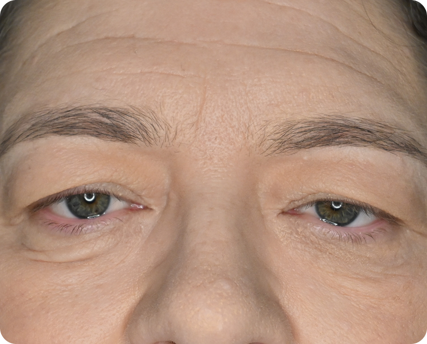 Nahaufnahme der Augen und des oberen Gesichts einer Person mit hängenden Augenlidern und sichtbaren Falten auf der Haut.