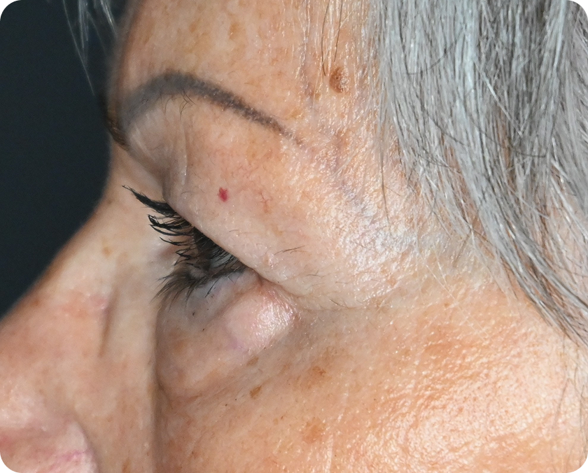 Seitliche Nahaufnahme des Gesichts einer älteren Person, die eine faltige Augenpartie, graue Haare und ein kleines Muttermal auf der Haut in der Nähe der Augenbraue zeigt.
