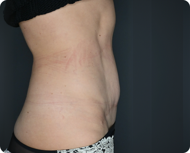 Seitenansicht des Mittelteils einer Person mit lockerer Haut und leichten Dehnungsstreifen am Bauch, die gemusterte Unterwäsche vor einem dunklen Hintergrund trägt.