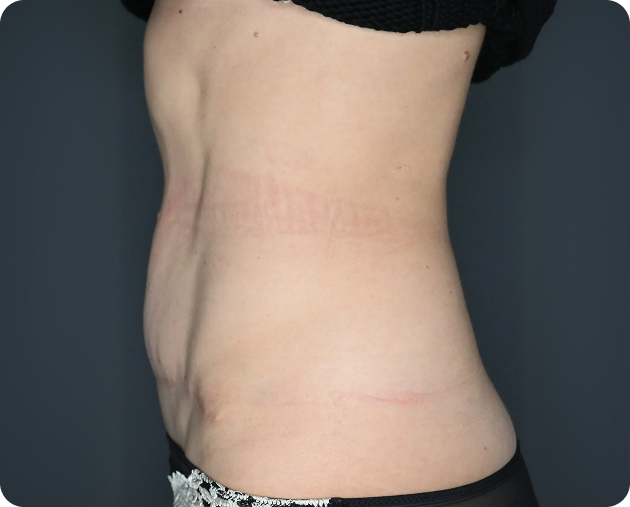 Seitliche Nahaufnahme des nackten Oberkörpers und Bauches einer Person mit leichten Dehnungsstreifen und leichten Hautfalten vor einem dunklen Hintergrund.