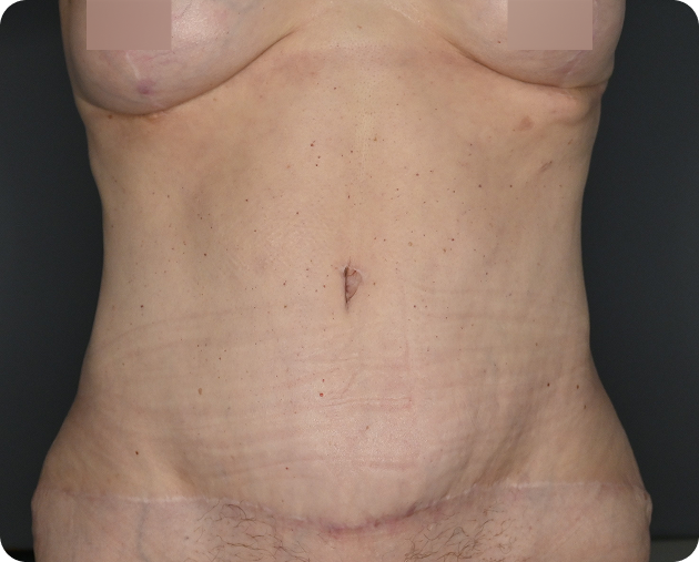Eine Nahaufnahme des Oberkörpers einer Person, die eine verheilte chirurgische Narbe zeigt, die horizontal über den Unterbauch verläuft.