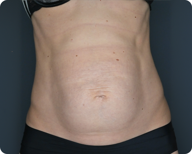 Der nackte Bauch einer Person ist vor einem dunklen Hintergrund mit sichtbaren Bauchwülsten und einigen Hautfalten dargestellt.