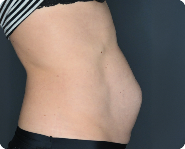 Seitliche Nahaufnahme des nackten Bauches einer Person mit sichtbaren Blähungen, die schwarze Unterwäsche und ein gestreiftes Oberteil trägt.