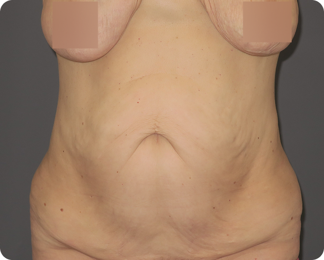 Der nackte Oberkörper einer Person in der Frontalansicht, die lose, schlaffe Haut und Dehnungsstreifen am Bauch zeigt. Brüste und Brustwarzen sind aus Gründen der Privatsphäre teilweise unscharf.