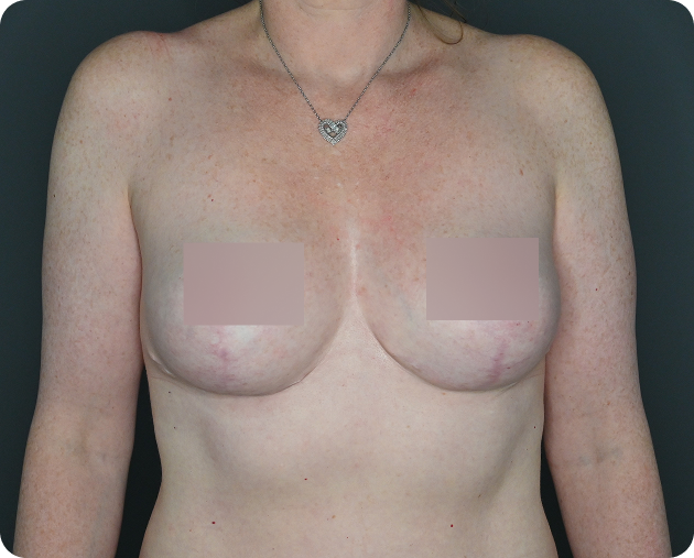 Eine Frau mit sichtbaren postoperativen Narben an beiden Brüsten, die vor einem dunklen Hintergrund stehen; die Brust ist aus Gründen der Privatsphäre teilweise zensiert.