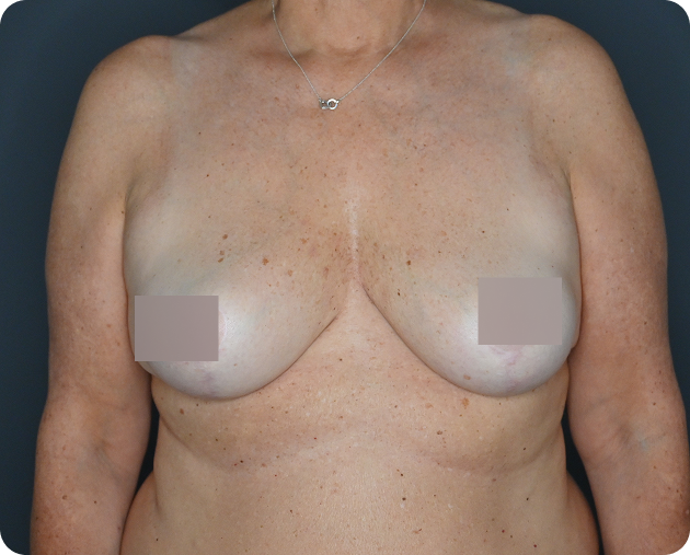 Eine Frau mittleren Alters mit sichtbaren Unterschieden in Form und Größe der Brüste vor einem schlichten, dunklen Hintergrund; die Brustwarzen sind zum Schutz der Privatsphäre zensiert.