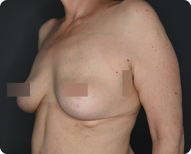Der Torso einer Frau wird von der Seite gezeigt; eine Brust erscheint mit einer sichtbaren Narbe rekonstruiert, während die andere Brust natürlich aussieht. Die Brustwarzen sind aus Gründen der Privatsphäre unscharf.