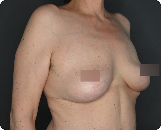 Der Torso einer Frau wird von der Seite gezeigt; sie scheint eine Mastektomie und eine Brustrekonstruktion auf der linken Seite gehabt zu haben. Beide Brustwarzen sind zensiert.