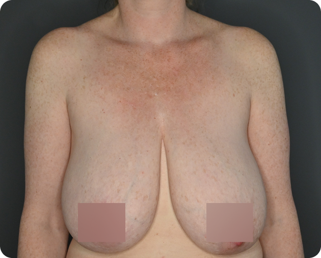 Die nackte Brust einer Frau wird von den Schultern bis unter die Brüste gezeigt, wobei die Brustwarzen aus Gründen der Privatsphäre verdeckt sind. Die Haut ist leicht gerötet und ungleichmäßig gefärbt.