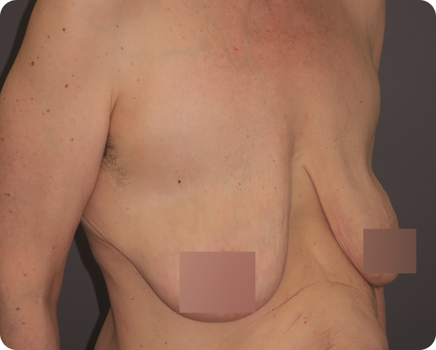 Der Torso einer Person in der Seitenansicht mit sichtbarer Ptose und erschlaffter Haut; die Brustwarzen sind aus Gründen der Privatsphäre zensiert.