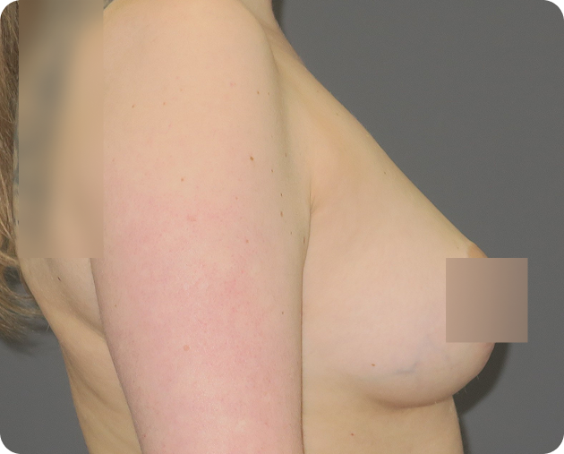 Eine Seitenansicht des nackten Oberkörpers und Arms einer Person vor einem neutralen Hintergrund, wobei der Brustbereich aus Gründen der Bescheidenheit teilweise unscharf ist.