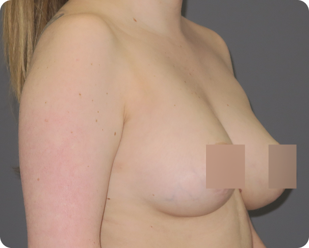 Eine Frau wird von der Seite mit nacktem Oberkörper vor einem neutralen Hintergrund gezeigt; der Brustbereich ist zum Schutz der Privatsphäre zensiert.
