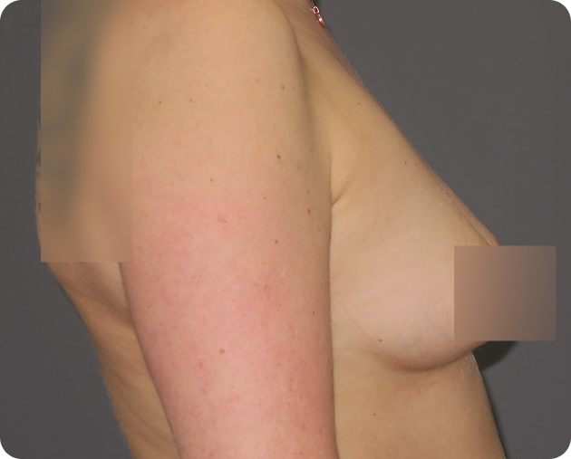 Seitenansicht des nackten Oberkörpers einer Person mit teilweise zensierter Brust und einfarbigem Hintergrund.