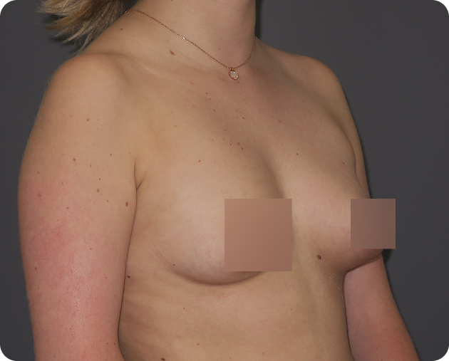 Eine Person mit heller Haut und schulterlangem blondem Haar, von den Schultern bis zur Taille, posiert vor einem schlichten Hintergrund. Der Brustbereich ist zum Schutz der Privatsphäre teilweise zensiert.