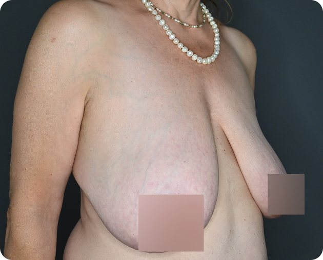Eine Frau mit asymmetrischen Brüsten und sichtbaren postoperativen Veränderungen auf der linken Seite ihrer Brust vor einem dunklen Hintergrund.