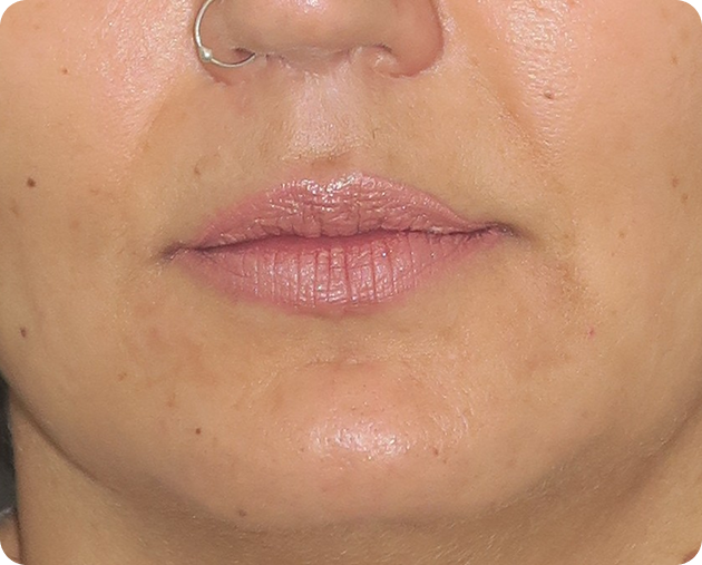 Eine Nahaufnahme des unteren Gesichts einer Person mit Lippen, einem Teil der Nase, einem Nasenring und einigen Sommersprossen oder Leberflecken auf der Haut.