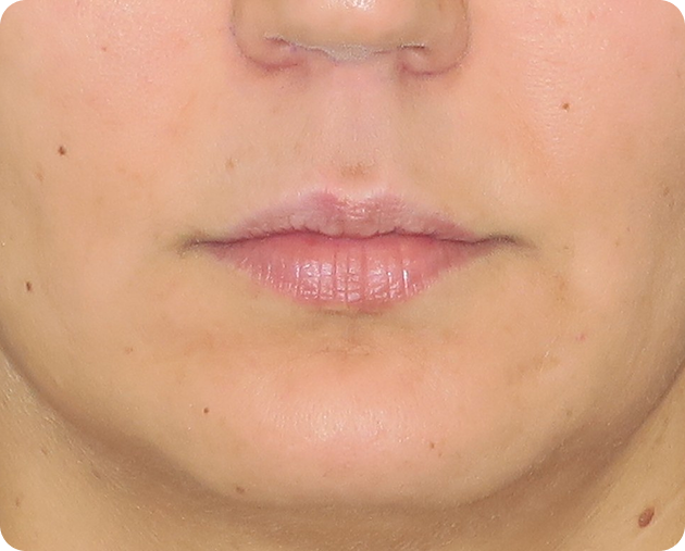 Nahaufnahme der unteren Gesichtshälfte einer Person, wobei der Schwerpunkt auf den Lippen und der umgebenden Haut liegt.
