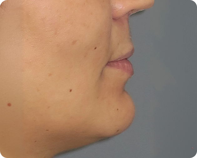 Profilansicht des unteren Gesichts einer Person, die die Hautstruktur, die Lippen und das Kinn vor einem neutralen Hintergrund zeigt.